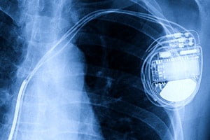 
            Active Implantable Medical Devices