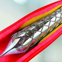 Dispositifs médicaux vasculaires BSI Dispositifs médicaux vasculaires BSI